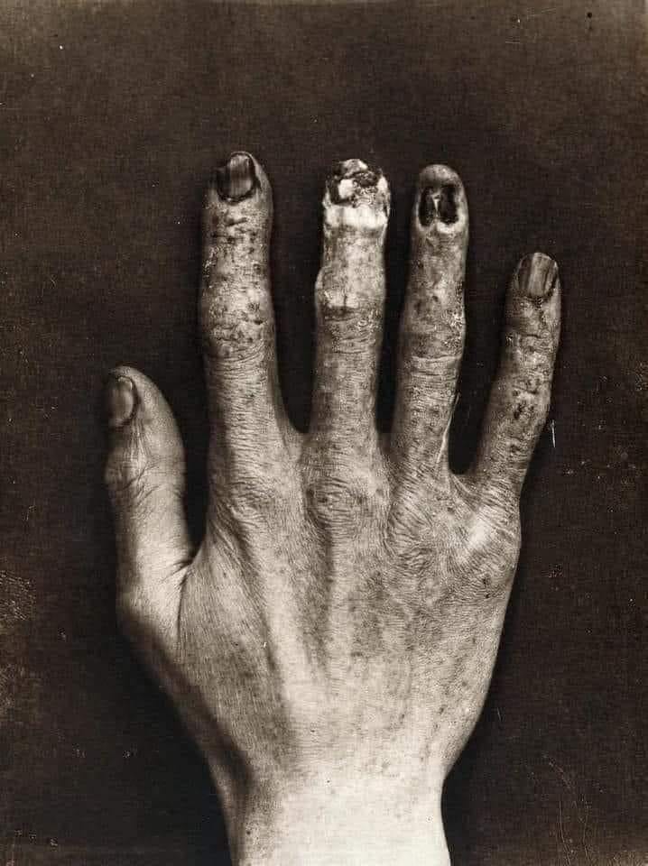 In the 1920s, the Radium Girls were hired by factories to cover glow-in-the-dark watches with luminous paint. 

A glamorous job for an irresistibly popular product, but the girls d