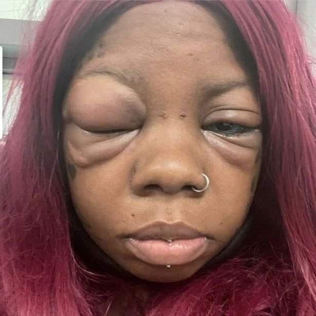 Woman who tattooed her eyeballs is now going blind...
A mum admits she regrets not listening to her daughter’s warning she could go blind if she got her eyeballs tattooed – as she