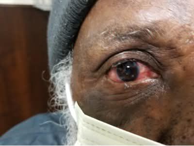 Breaking Hush hush news!
Politician Charged with Crazy Glue Eyelid Prank
Nassau, The Bahamas (June 25, 2023) - A sitting politician was charged today with gluing his father's eye