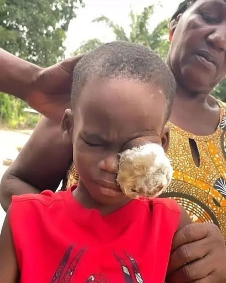 Did this happen in Abaco? 

It's a disease from cockroach bites. 

See comments for video.